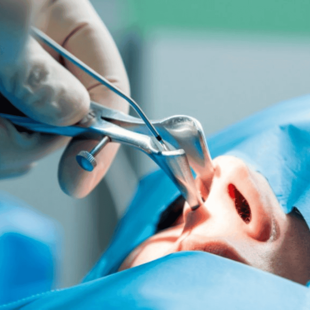 Cirurgia otorrinolaringologia - CGO Clínica - Septo